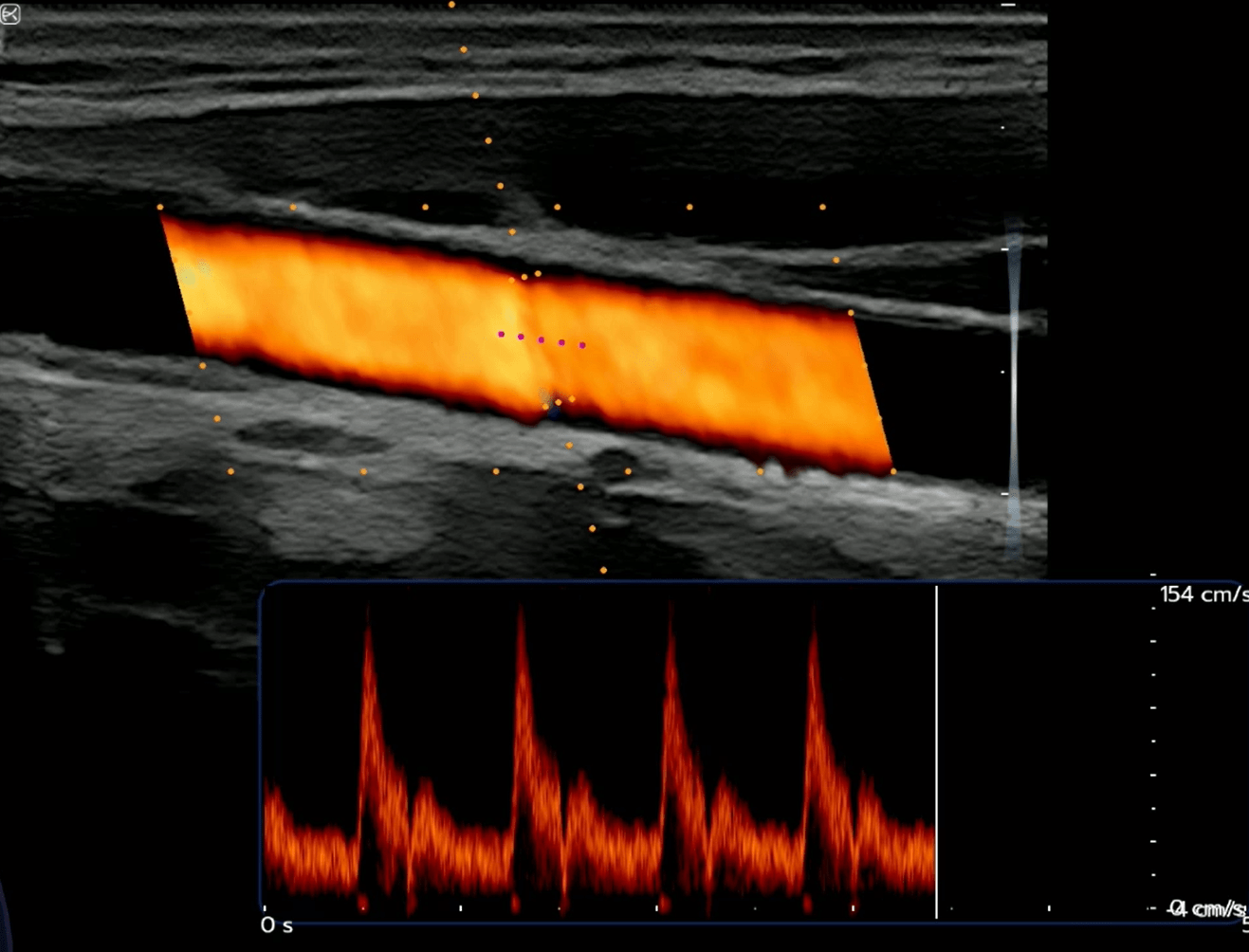 Carotid auto flow