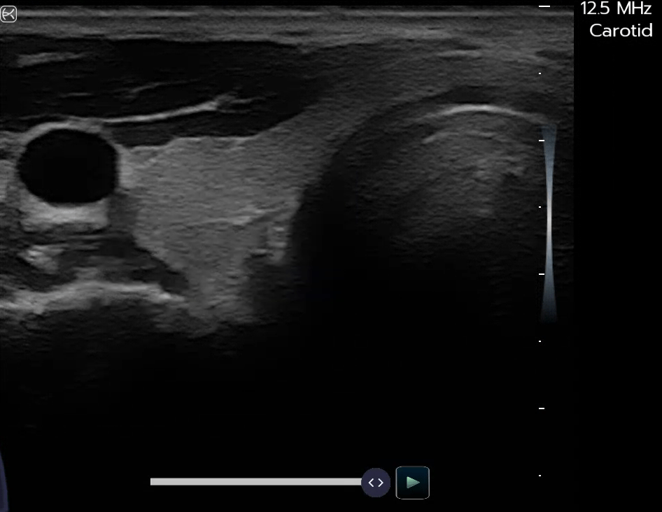 Thyroid