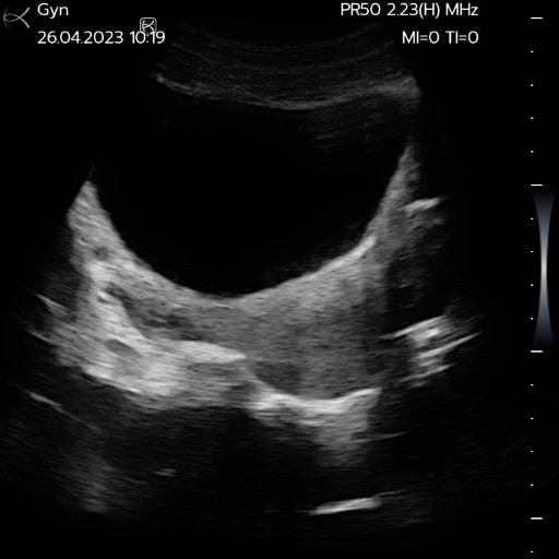 Uterus