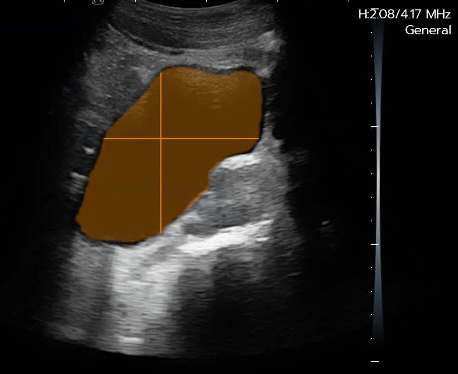 Bladder Scanner
