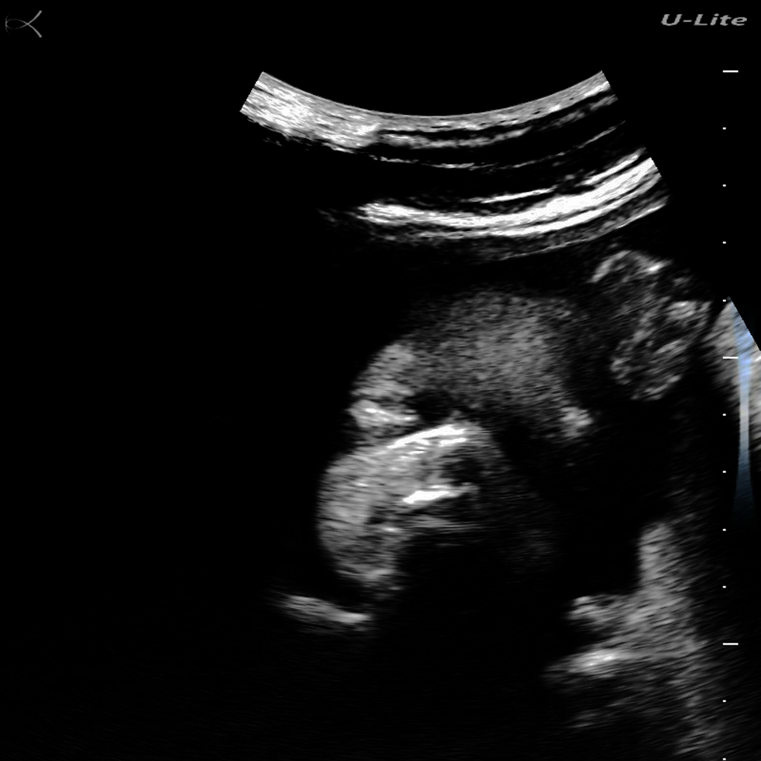 Fetus